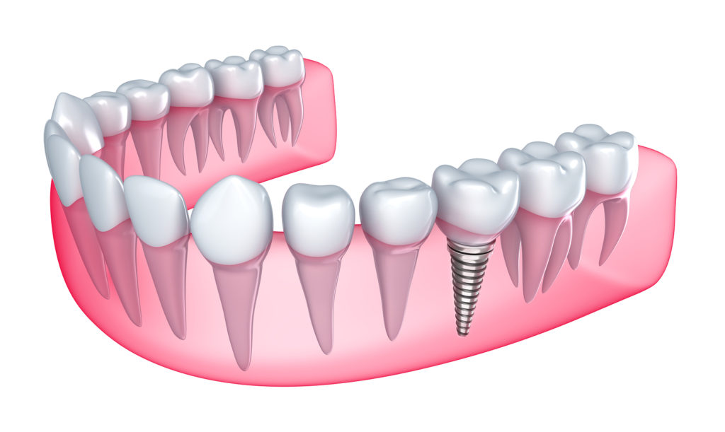 dental-implants-2