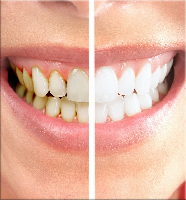 veneers2