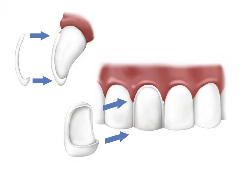 veneers3